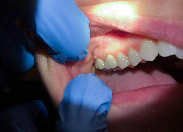 Best Emergency Dentist for Knocked-Out Tooth in Campbell, MO