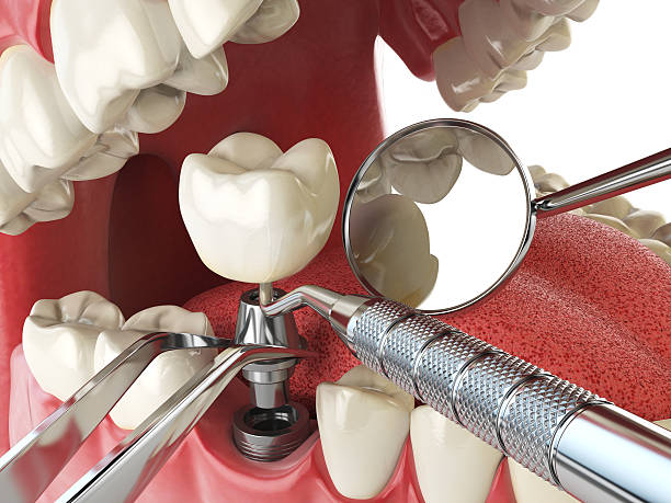 Best Emergency Dental Care for Abscessed Tooth in Campbell, MO